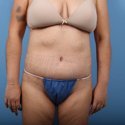 Body Lift Before & After Gallery - Patient 813714 - Image 2
