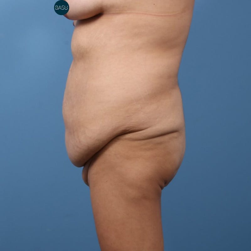 Body Lift Before & After Gallery - Patient 813714 - Image 3