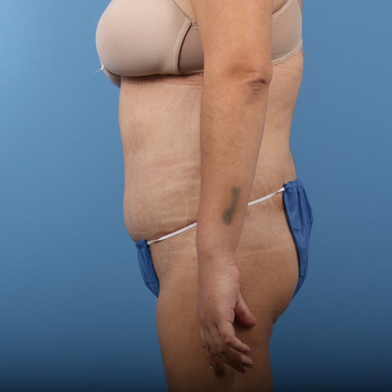 Body Lift Before & After Gallery - Patient 813714 - Image 4