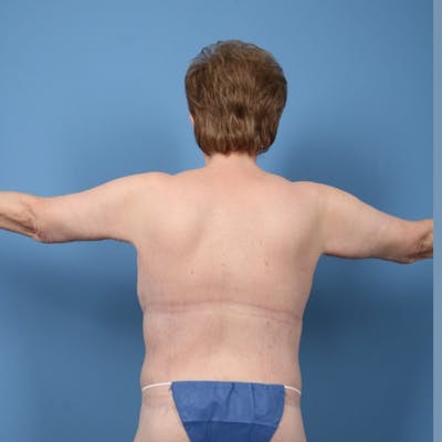 Body Lift Before & After Gallery - Patient 646078 - Image 2
