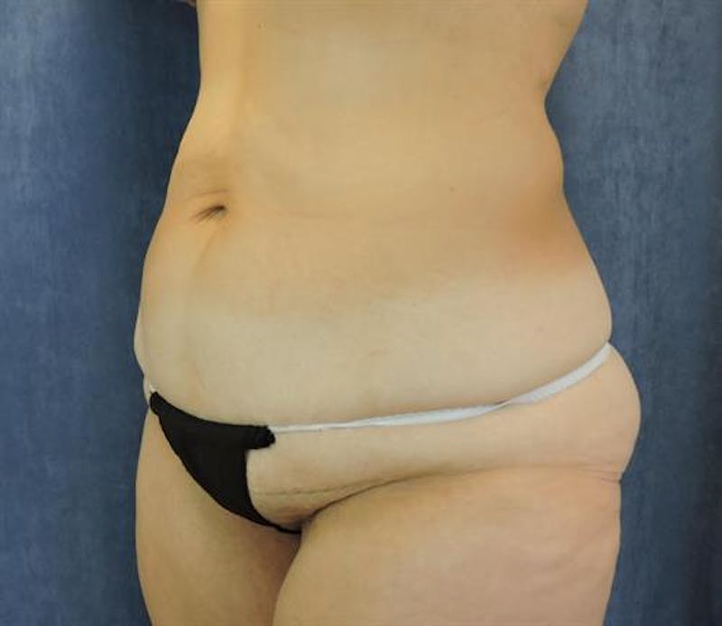Body Lift Before & After Gallery - Patient 231201 - Image 3