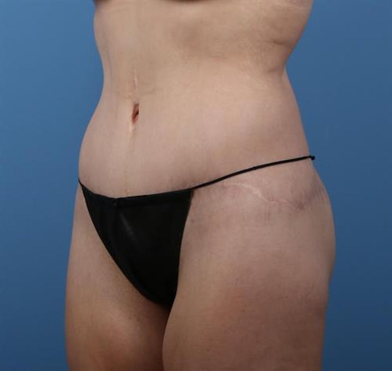 Body Lift Before & After Gallery - Patient 231201 - Image 4