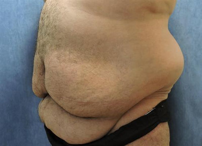 Body Lift Before & After Gallery - Patient 150835 - Image 3