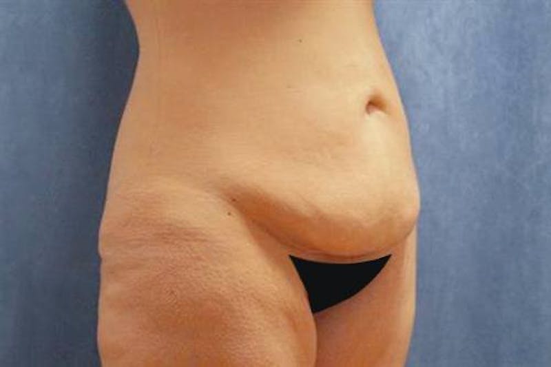 Body Lift Before & After Gallery - Patient 359666 - Image 3
