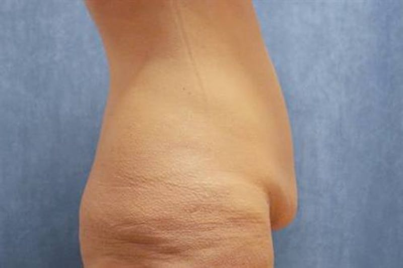Body Lift Before & After Gallery - Patient 359666 - Image 5