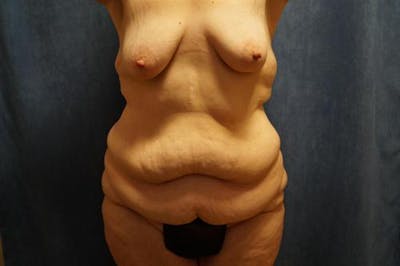 Body Lift Before & After Gallery - Patient 132659 - Image 1