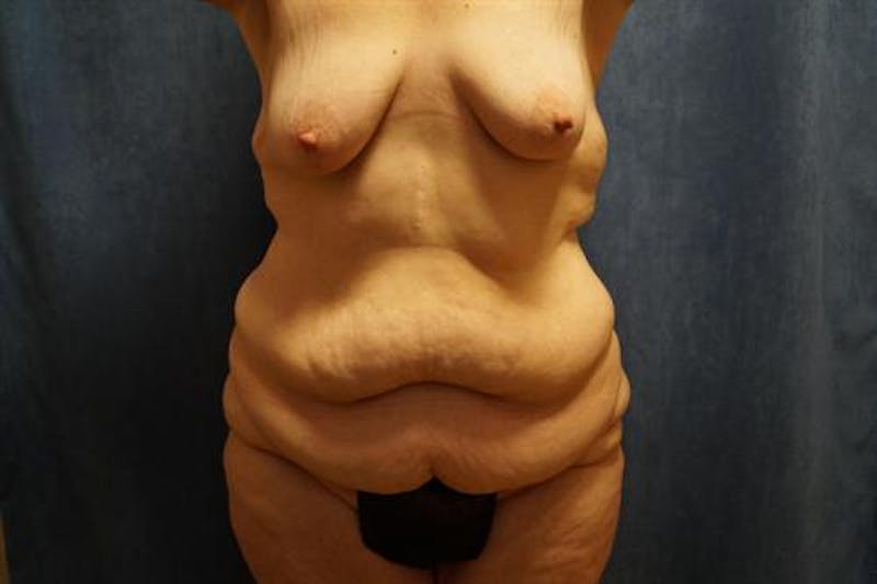 Body Lift Before & After Gallery - Patient 132659 - Image 1