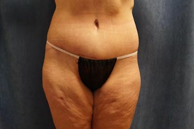 Body Lift Before & After Gallery - Patient 132659 - Image 2