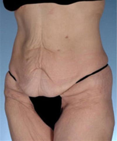 Body Lift Before & After Gallery - Patient 203259 - Image 1