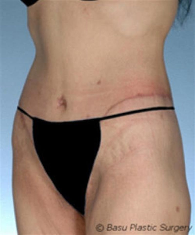 Body Lift Before & After Gallery - Patient 203259 - Image 2