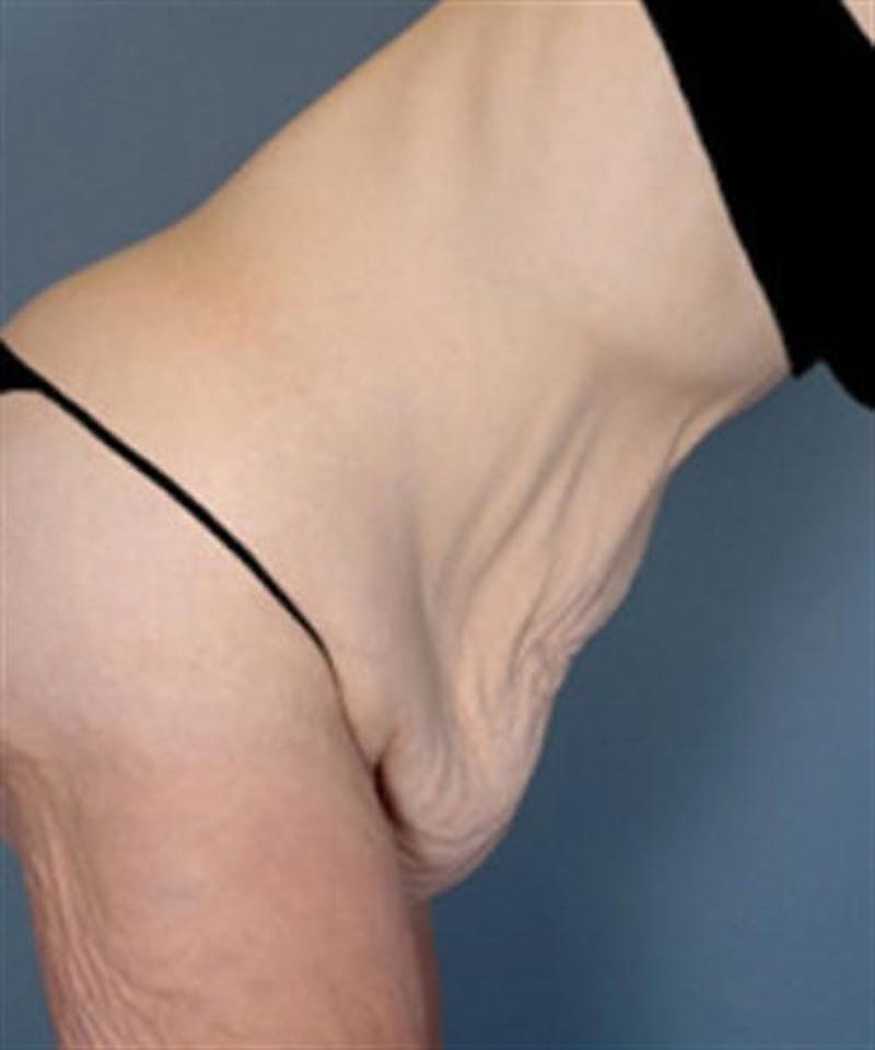 Body Lift Before & After Gallery - Patient 203259 - Image 3