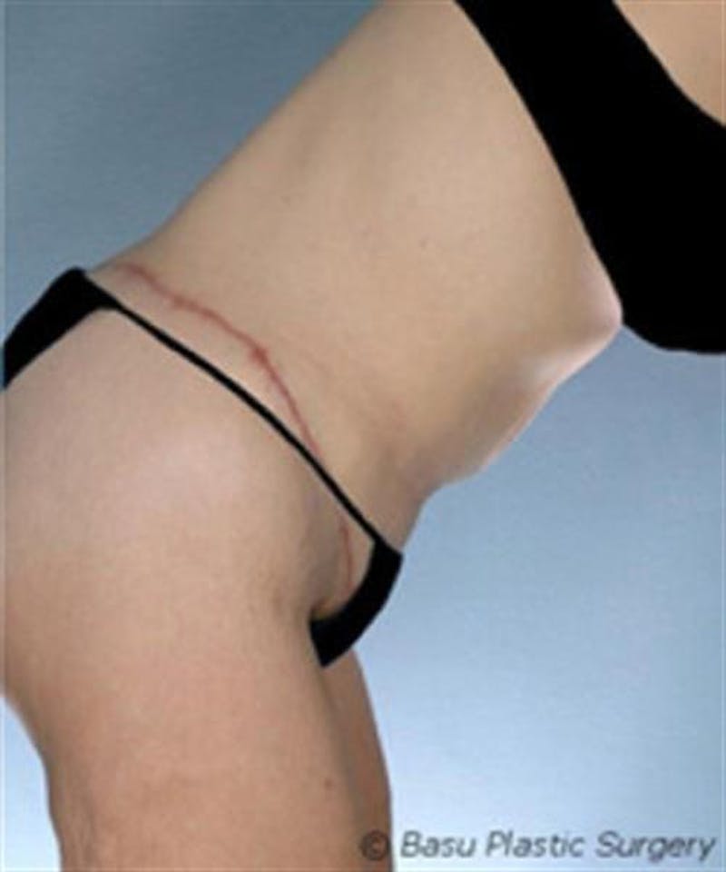 Body Lift Before & After Gallery - Patient 203259 - Image 4