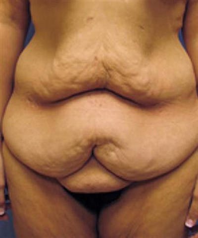 Body Lift Before & After Gallery - Patient 244513 - Image 1