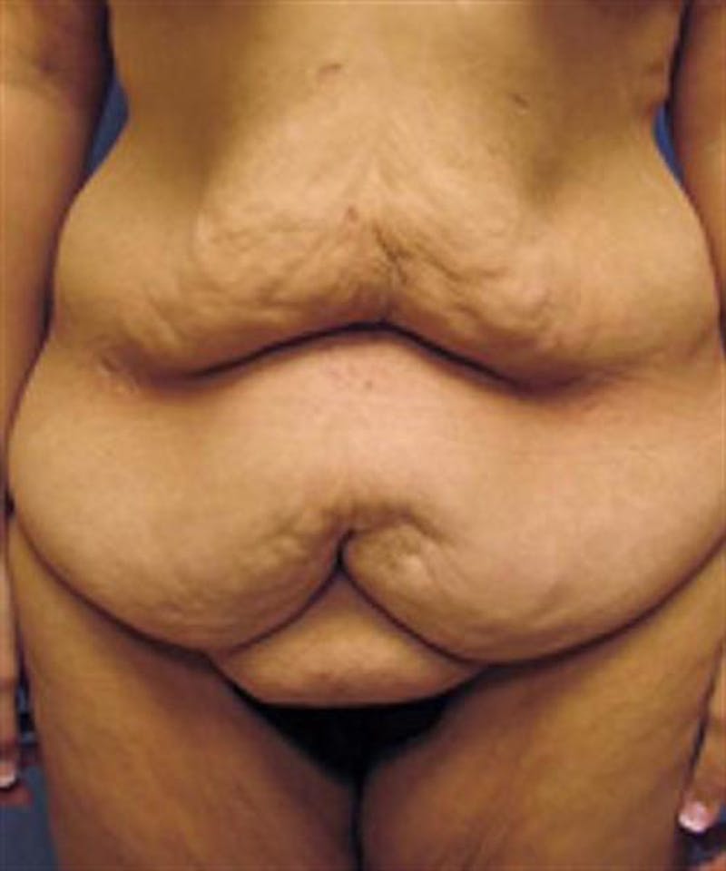 Body Lift Before & After Gallery - Patient 244513 - Image 1