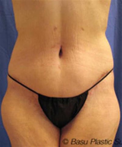 Body Lift Before & After Gallery - Patient 244513 - Image 2