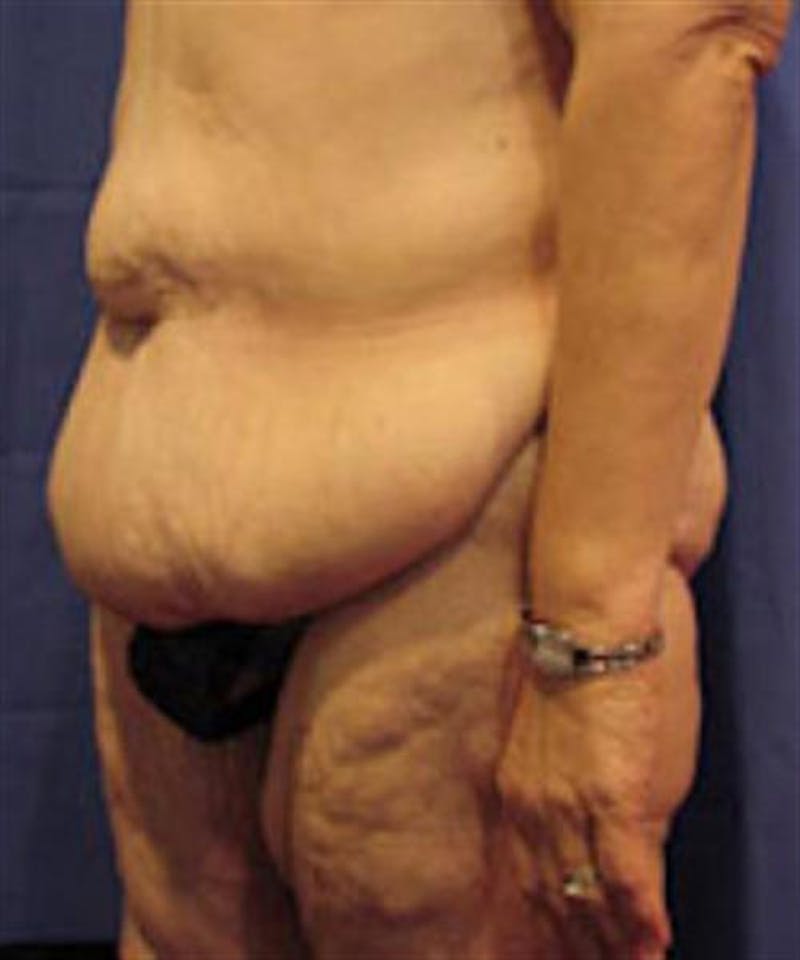 Body Lift Before & After Gallery - Patient 244513 - Image 3