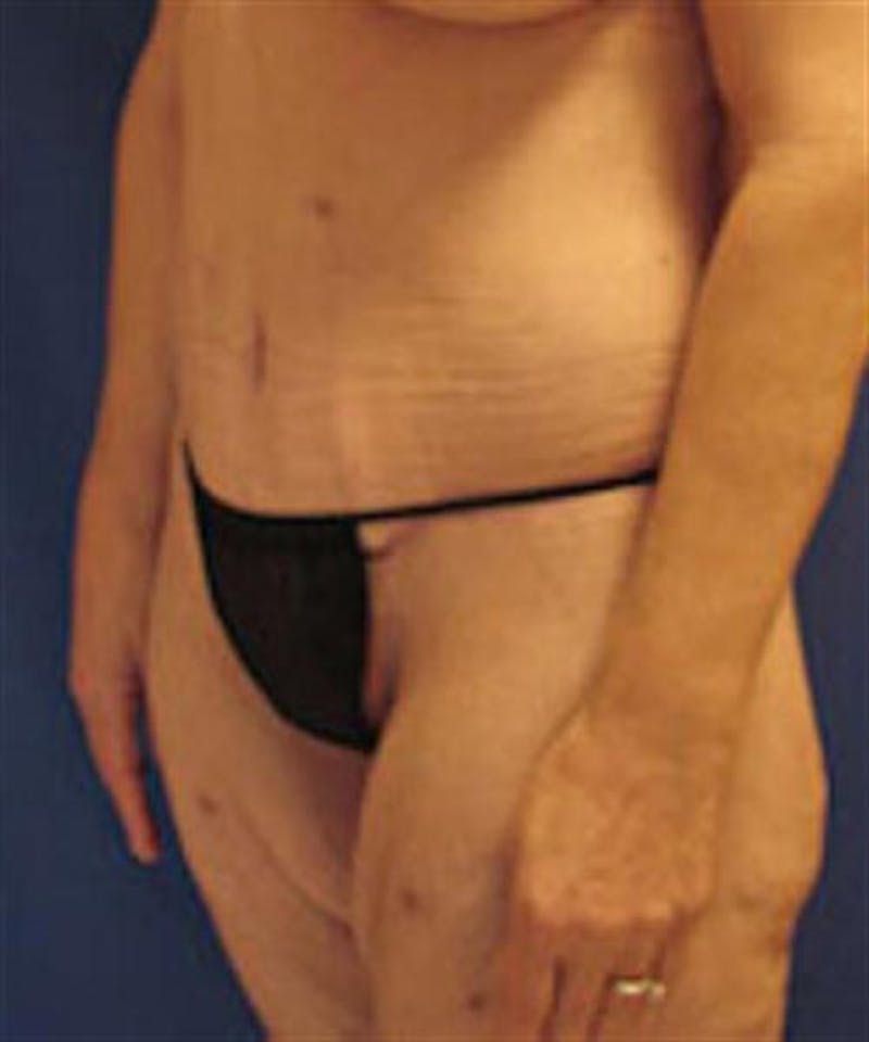 Body Lift Before & After Gallery - Patient 244513 - Image 4