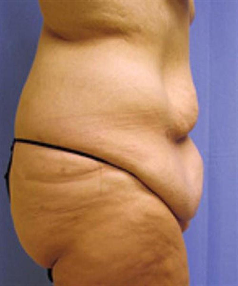 Body Lift Before & After Gallery - Patient 244513 - Image 5