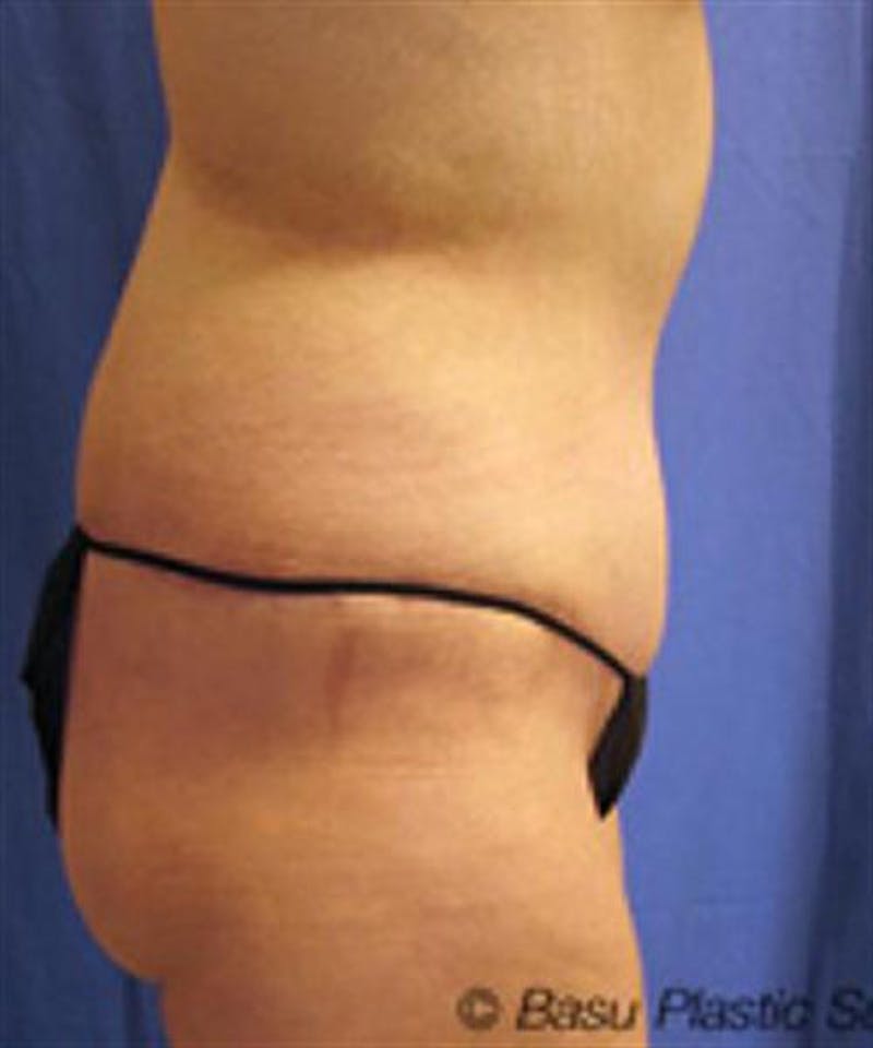 Body Lift Before & After Gallery - Patient 244513 - Image 6
