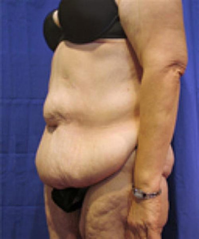 Body Lift Before & After Gallery - Patient 395450 - Image 1