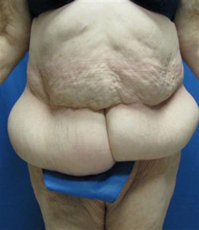 Body Lift Before & After Gallery - Patient 287886 - Image 1