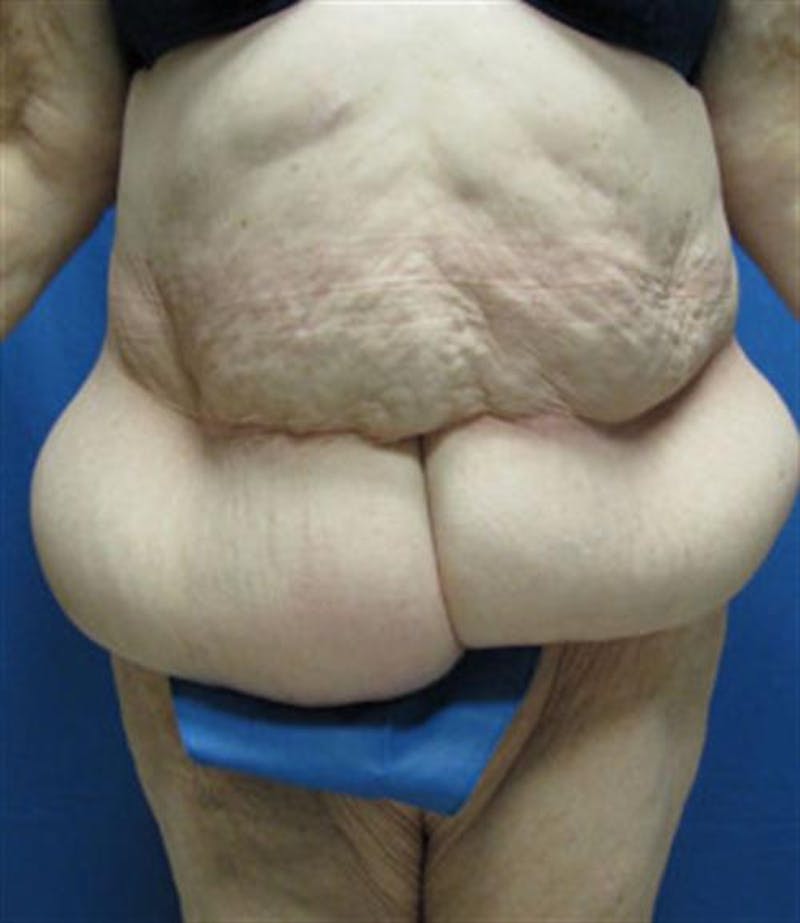 Body Lift Before & After Gallery - Patient 287886 - Image 1