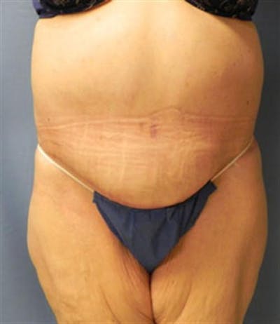 Body Lift Before & After Gallery - Patient 287886 - Image 2