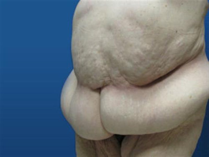 Body Lift Before & After Gallery - Patient 287886 - Image 3