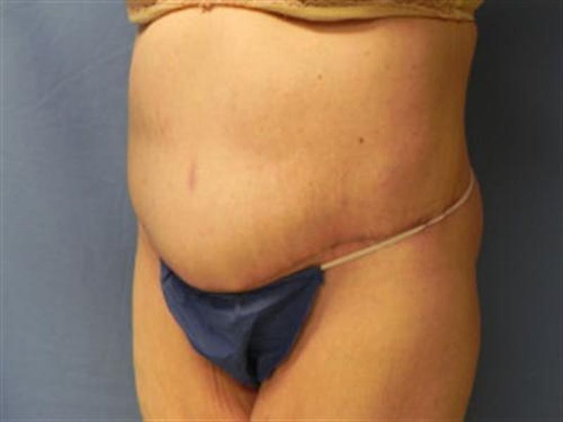 Body Lift Before & After Gallery - Patient 287886 - Image 4
