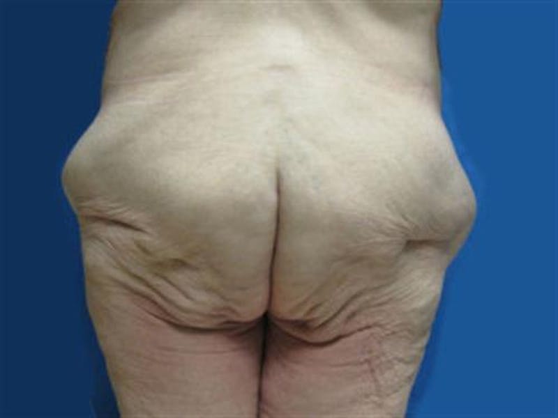 Body Lift Before & After Gallery - Patient 287886 - Image 5