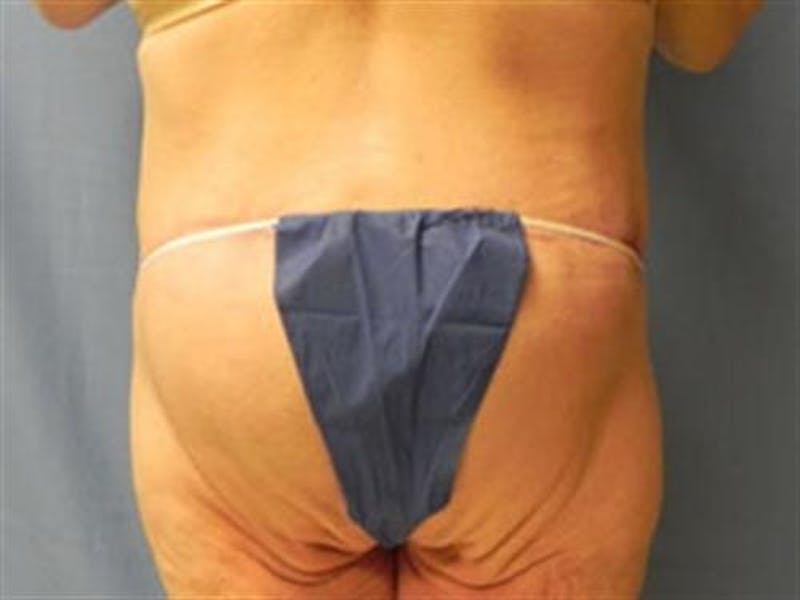 Body Lift Before & After Gallery - Patient 287886 - Image 6