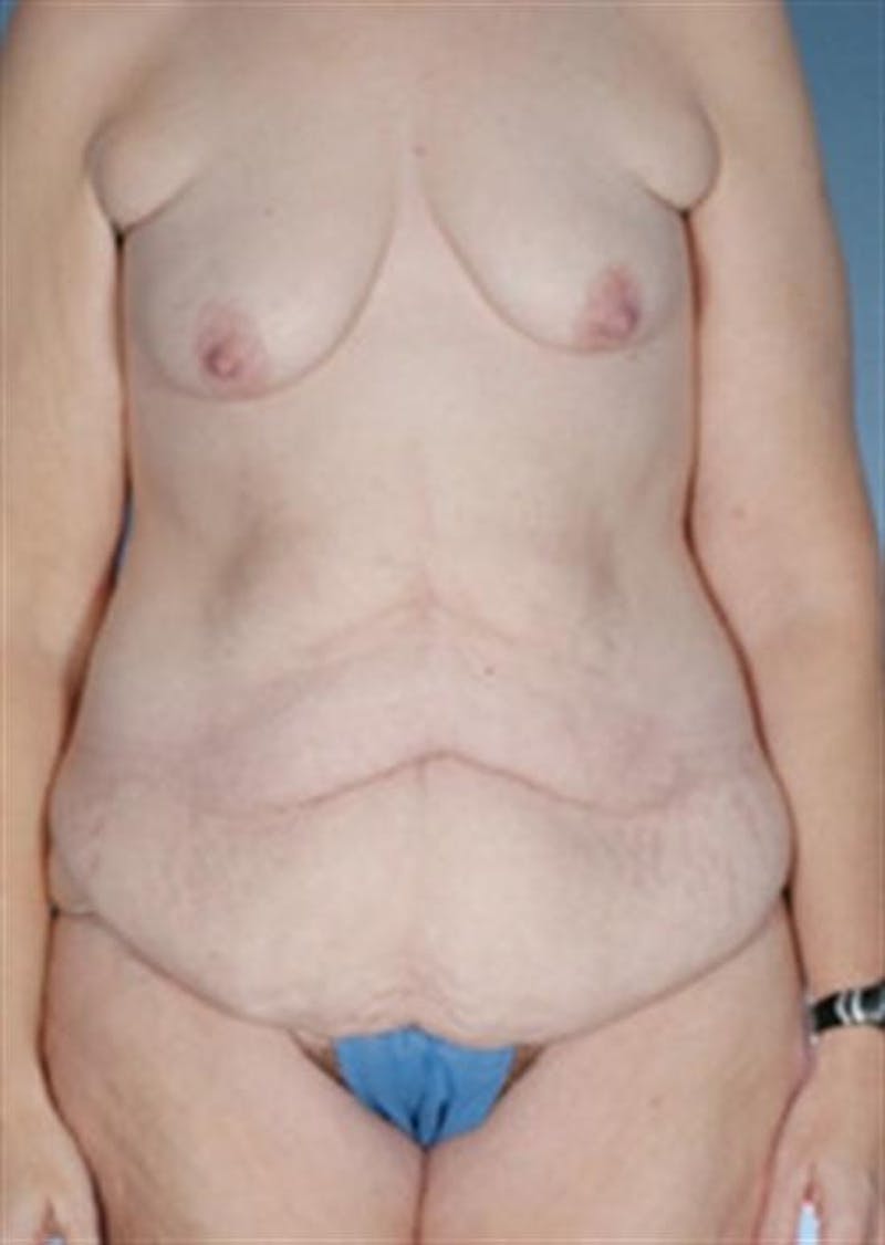 Body Lift Before & After Gallery - Patient 347349 - Image 1