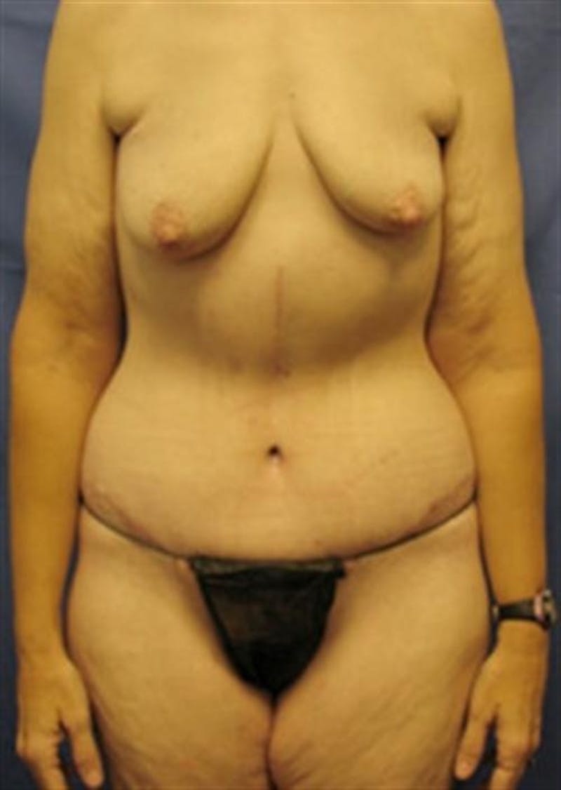 Body Lift Before & After Gallery - Patient 347349 - Image 2