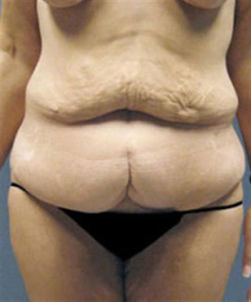 Body Lift Before & After Gallery - Patient 179834 - Image 1