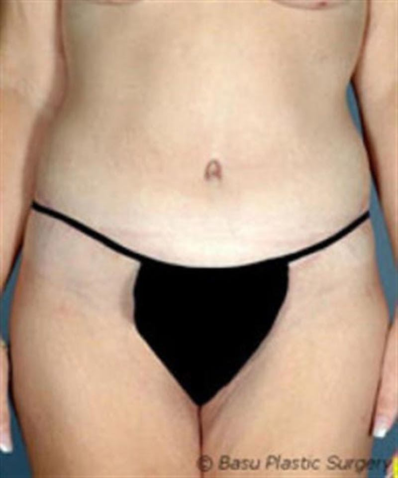 Body Lift Before & After Gallery - Patient 179834 - Image 2