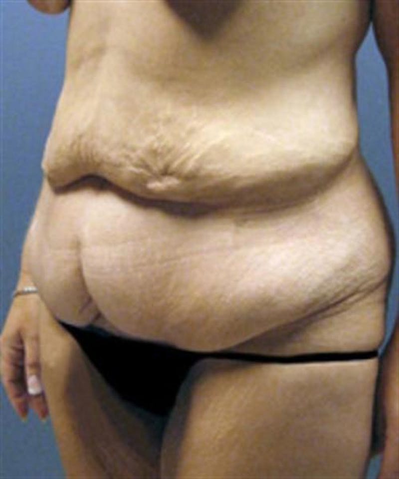 Body Lift Before & After Gallery - Patient 179834 - Image 3