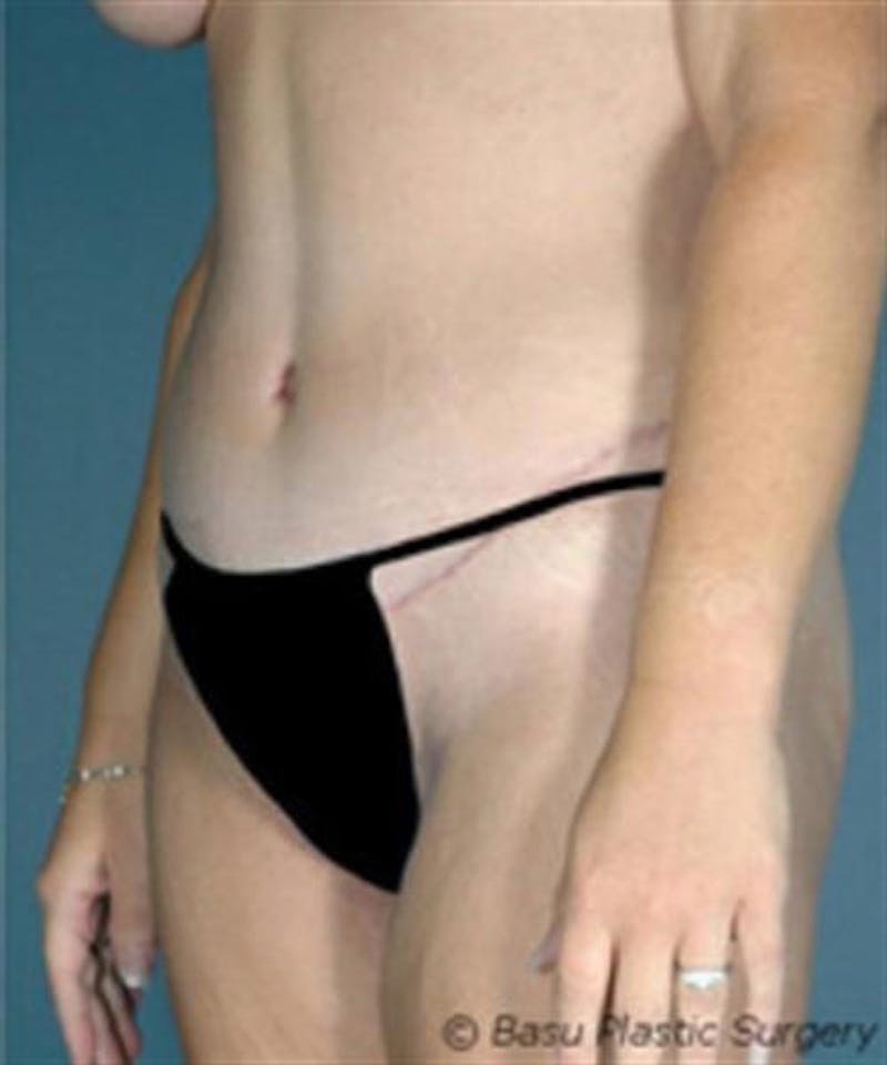 Body Lift Before & After Gallery - Patient 179834 - Image 4