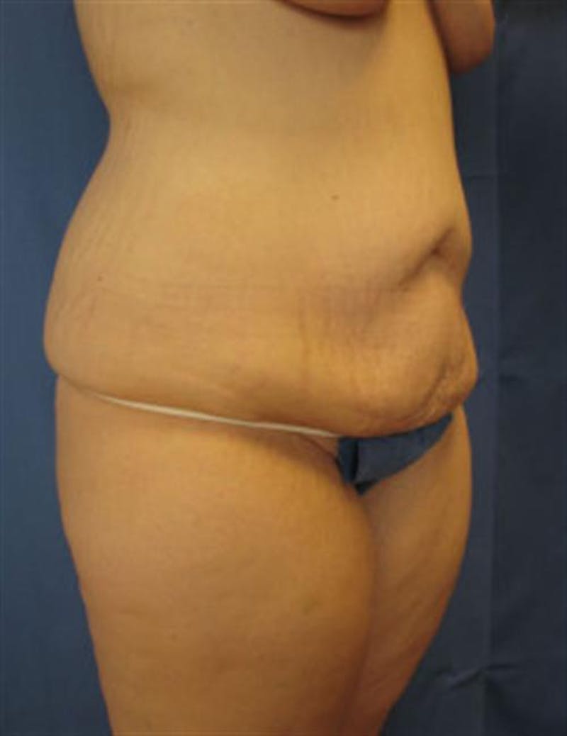 Body Lift Before & After Gallery - Patient 182359 - Image 1