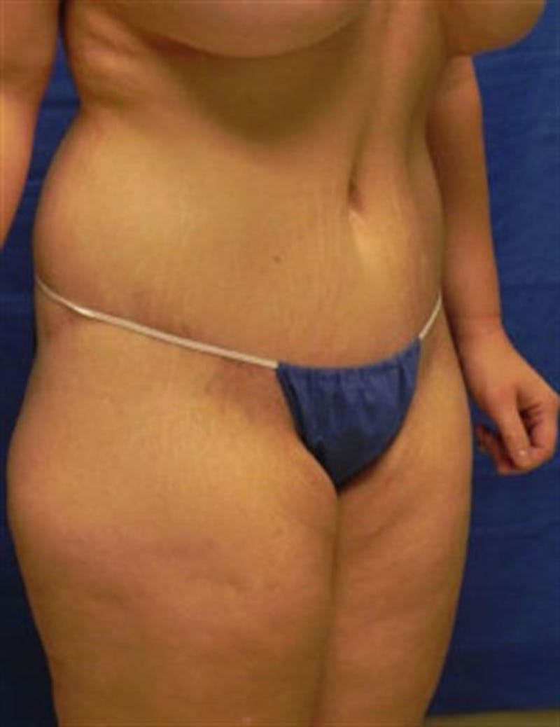 Body Lift Before & After Gallery - Patient 182359 - Image 2