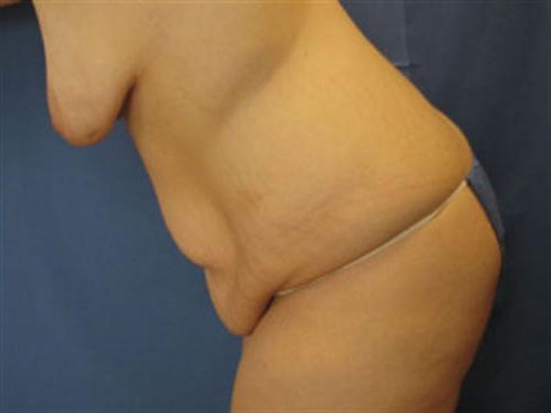 Body Lift Before & After Gallery - Patient 182359 - Image 3