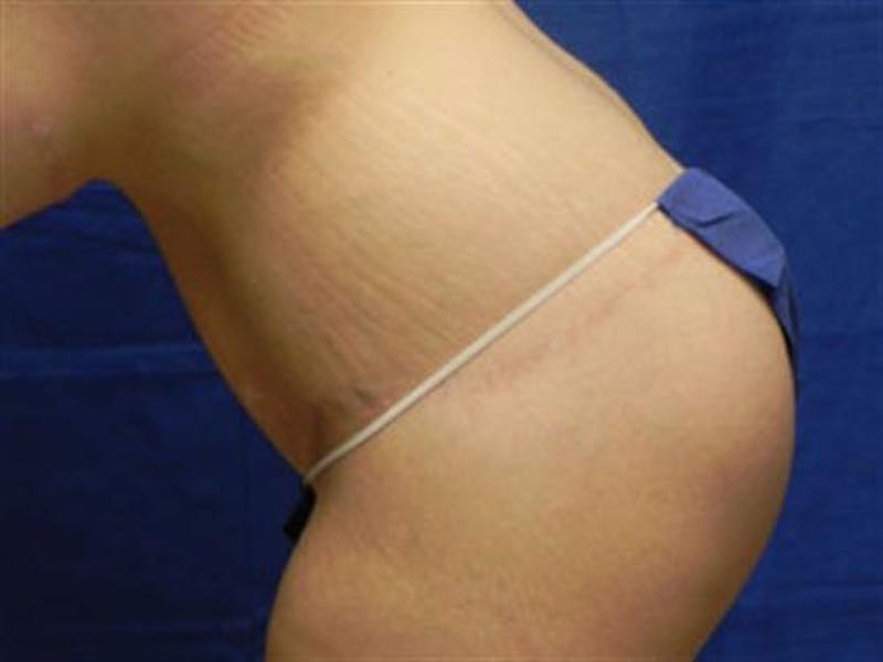 Body Lift Before & After Gallery - Patient 182359 - Image 4