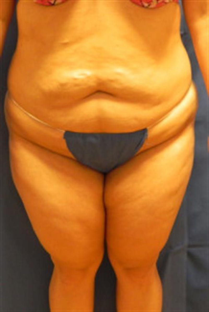 Body Lift Before & After Gallery - Patient 404379 - Image 1