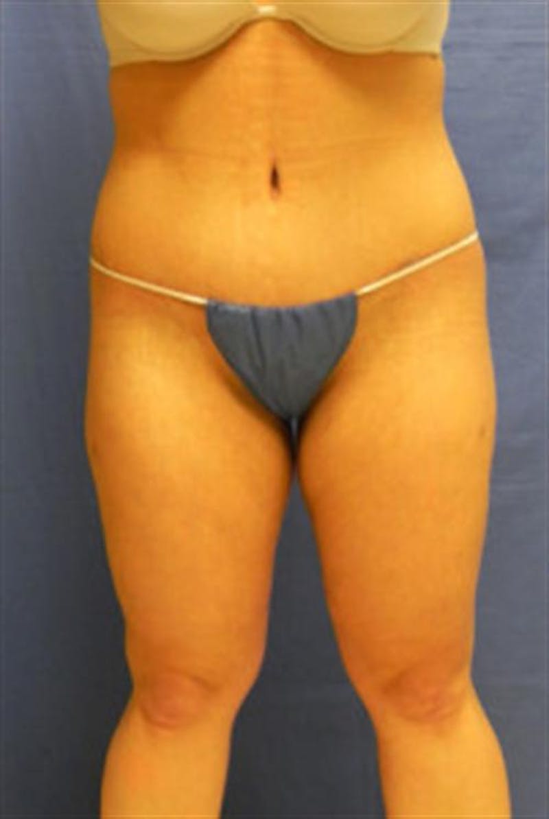 Body Lift Before & After Gallery - Patient 404379 - Image 2
