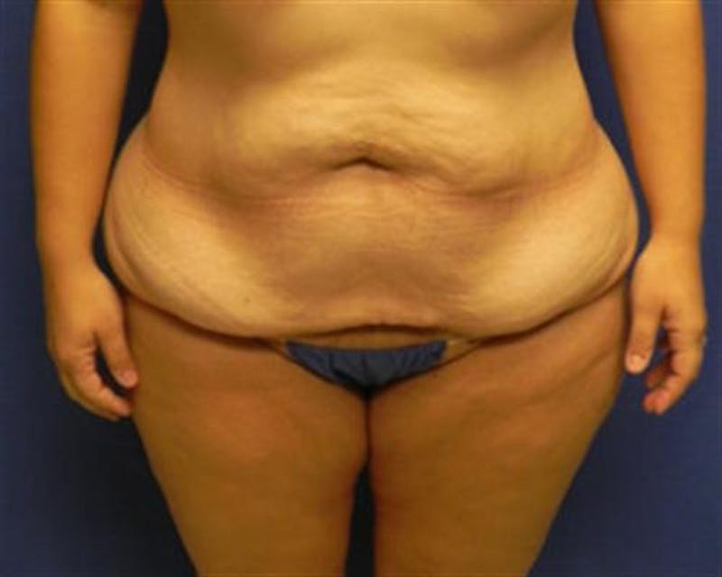 Body Lift Before & After Gallery - Patient 202104 - Image 1