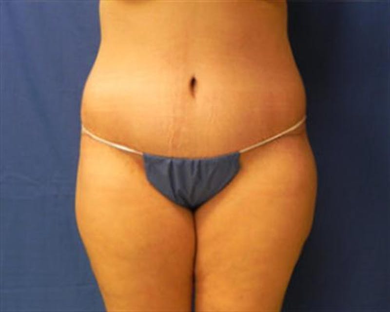 Body Lift Before & After Gallery - Patient 202104 - Image 2