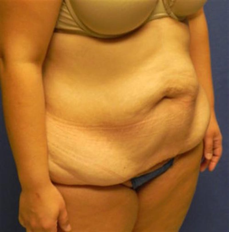 Body Lift Before & After Gallery - Patient 202104 - Image 3