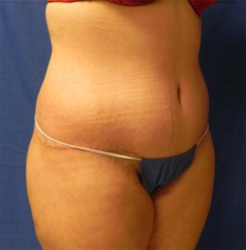 Body Lift Before & After Gallery - Patient 202104 - Image 4