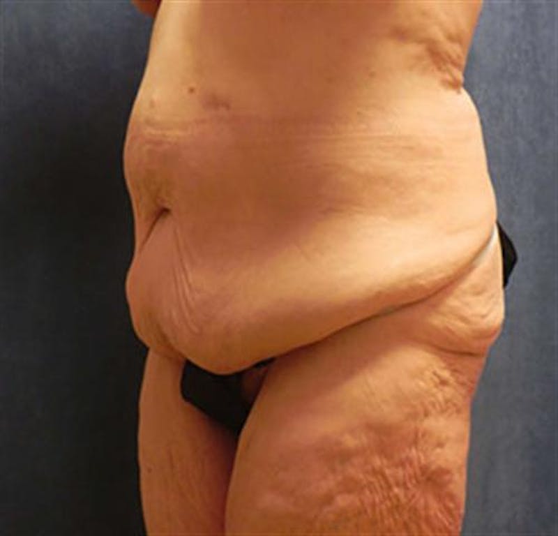 Body Lift Before & After Gallery - Patient 224361 - Image 1