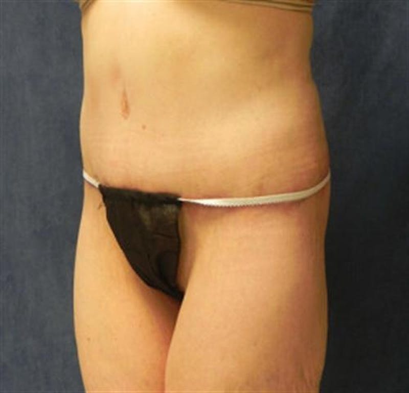Body Lift Before & After Gallery - Patient 224361 - Image 2