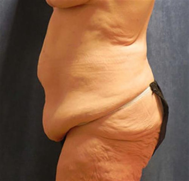 Body Lift Before & After Gallery - Patient 224361 - Image 3